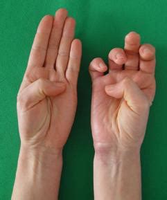 Ulnar neuropathy refers to pain, tingling, or numbness in one or both hands resulting from. Доктор Голобородько - fordoctors2_en.htm