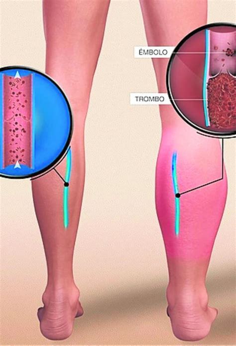 When a blood vessel (a vein or an artery) is injured, the body uses platelets (thrombocytes) and fibrin to form a blood clot to prevent blood loss. Trombosis : Dia Mundial De La Trombosis / Thrombosis is ...