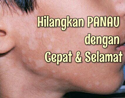 Penuhi waktu istirahat, usahakan minimal tidur 6 jam perhari, untuk membantu pertumbuhan. Cara Hilangkan Panau dengan Cepat dan Selamat ...