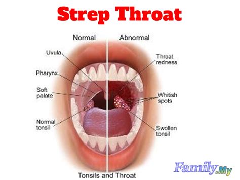 Sore throat may be caused by bacteria like group a beta hemolytic streptococcus. Strep Throat | Malaysia Health Family medicine and Healthcare