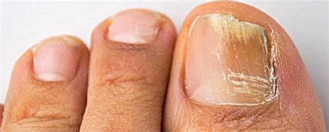 Cuticles protect your nails and skin from getting infected. Great Advice For Every Day Skin Care | Yellow toe nails ...