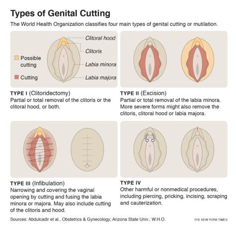 Labium minus smaller lip), also known as the inner labia, inner lips, vaginal lips or nymphae, are two flaps of skin on either side of the human vaginal opening in the vulva, situated between the labia majora (latin for larger lips; Surgery to remove labia clitoris