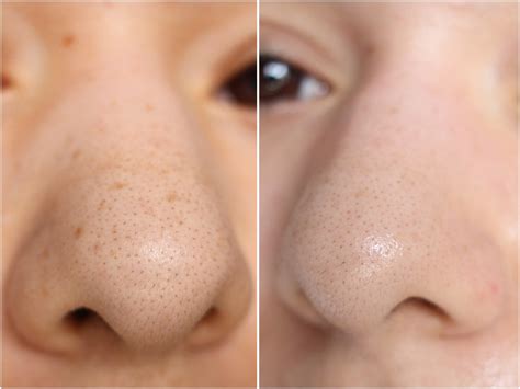 How to remove nose blackheads at home? First Impression | Holika Holika Pig Nose Clear Blackhead ...