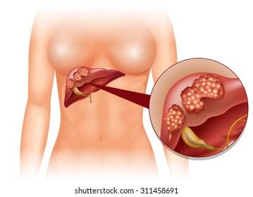 Apart from the pixel features, it is based on aosp. Liver Cancer Images, Stock Photos & Vectors | Shutterstock