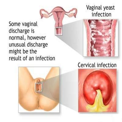 One possibility is a urinary track infection (uti). How To Get Rid Of Discharge Smell - Ways To Treat Of ...