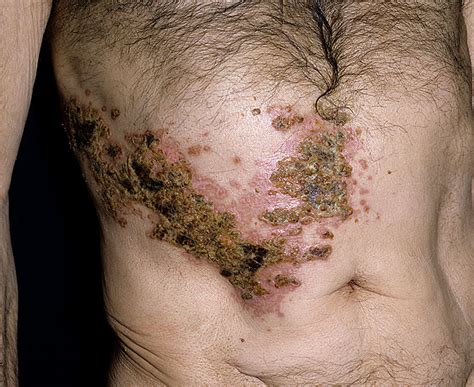 How long you've had it. Shingles Picture (Hardin MD Super Site Sample)