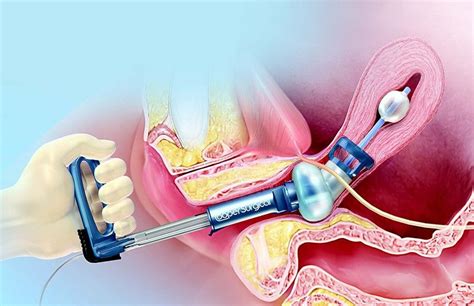 Comparing two uterine manipulators during total. Laparoscopic Uterine Manipulators