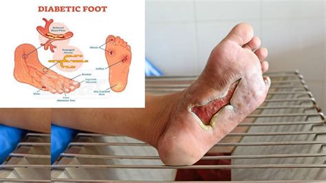 Maybe you would like to learn more about one of these? Kaki Hampir Di pot0ng, Kini Kencing Manis Telah Hil4ng ...