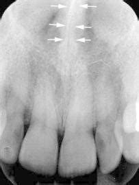 Nasal septal deviation (congenital or acquired), haematoma (trauma) or perforation (eg, trauma, nose picking, cocaine the valve is at the narrowest part of the nose and is the apex where the septum and the upper lateral cartilage meet. Dental Radiography Landmarks - Maxilla - Radiology 2014 ...