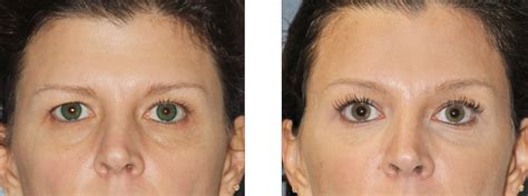 I pulled out one of the older ones i always used and it's definately 100% different. Brow Lift Gallery | Williamson Cosmetic Center | Before ...