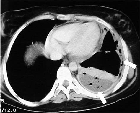 Ultrasound guided assessment of pleural effusion to determine and describe the size and site of the effusion. CT of empyema with loculated fluid and air in the pleural space (arrows). Satisfactory ...