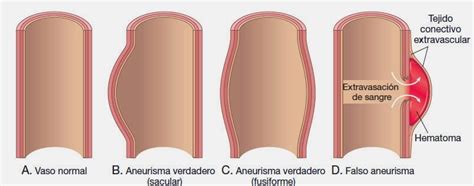 The word aneurysm comes from the latin word aneurysma, which means dilatation. Aneurisma: ¿Qué es? Síntomas, tipos, causas, tratamiento y ...