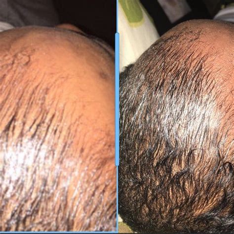 This serum is formulated to help tackle more difficult areas of hair loss including receding hairlines and bald spots. Hair Oil Formula D Hair ReGrowth Serum For Fast Hair ...