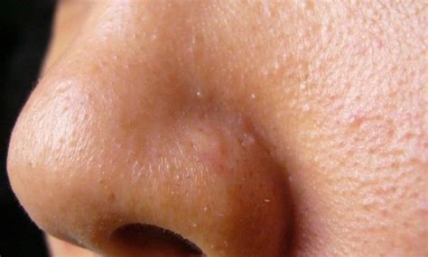 Kita bisa melakukan beberapa cara menghilangkan rasa ngantuk di bawah ini untuk melawannya. Whiteheads VS Milia: Apa Saja Perbedaan dan Cara ...