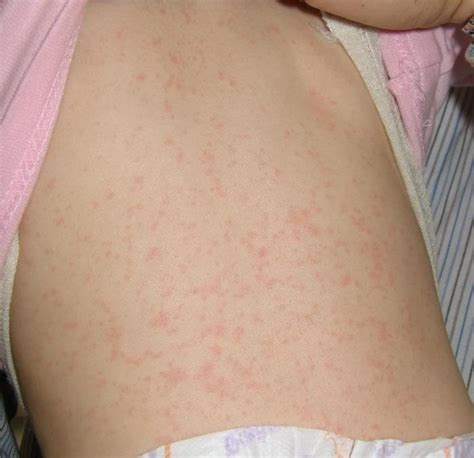 I used cortisone cream and covered that with the diaper cream. viral rash baby - pictures, photos