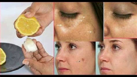 One may also use a thin slice of potato and keep it on the face where scars are present. 3 BEST TRICK TO REMOVE DARK SPOTS AND SCARS FROM THE FACE ...