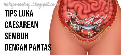 Berapa kali maksimal boleh operasi caesar resikonya apa. Tips Luka Caesarean Sembuh Dengan Pantas. (Berkesan ...