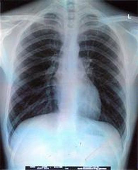 The human lungs are a pair of large, spongy organs optimized for gas exchange between our blood and the air. Bruised ribs from coughing | General center | SteadyHealth.com