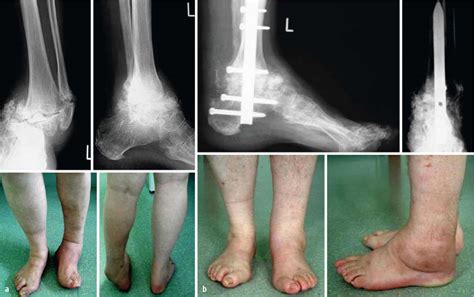 Möglicherweise unterliegen die inhalte jeweils zusätzlichen bedingungen. Charcot-Fuß | SpringerLink