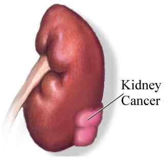 Still, it's important to have it checked by a doctor so the cause can be found. Kidney Cancer Signs, Symptoms and Treatment in Homeopathy ...