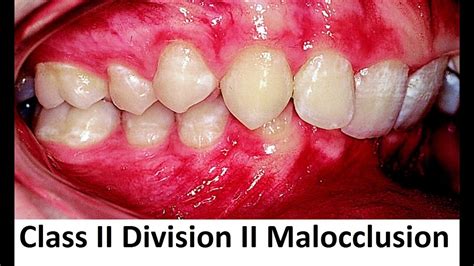 Groups iiia, iiib and iiic have not been adopted by the canadian electrical code. Can Class II Division II of Malocclusion Be Treated With ...
