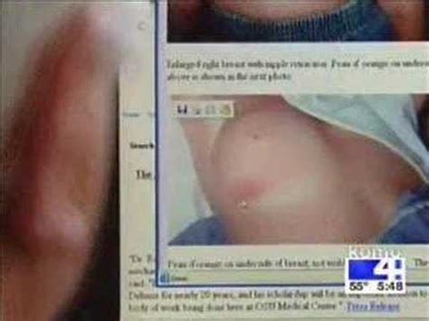 It can occur at any age (and, extremely rarely, in men). Breast Cancer your doctor will call a bug bite. | Kat's ...