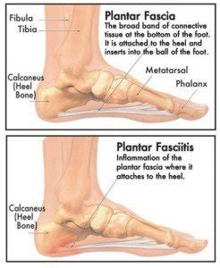 What kind of stretching and strengthening exercises should i do? Foot pain and plantar fasciitis | Family Physiotherapy ...