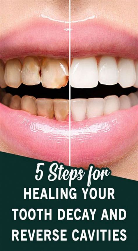 Teeth, just like any other part of your body, require your attention and proper care. 5 Steps For Healing Your Tooth Decay and Reverse Cavities ...