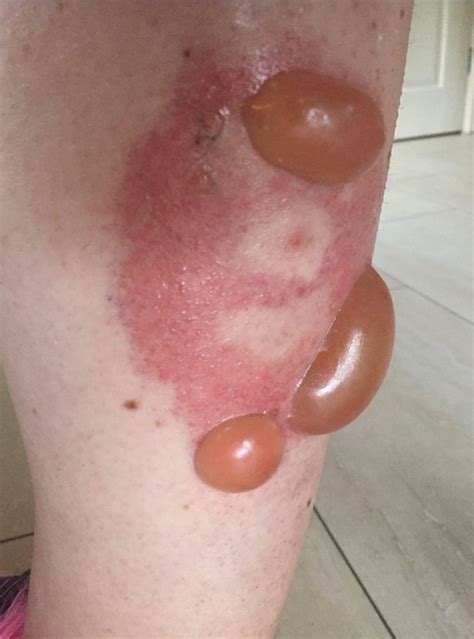 Initially a small white blister will appear where the brown recluse bit, the skin surrounding the newly form blister will also become swollen. Mum's horror as huge blisters grow on leg after false ...