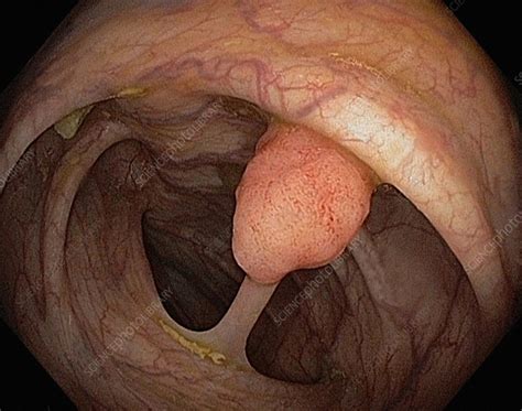 Webmd's colon anatomy page provides a detailed image and definition of the colon. Colon polyp - Stock Image - C014/6894 - Science Photo Library