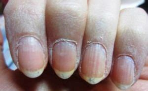 Remove dead skin around nails. Dry Skin around Nails: Causes, Vitamin Deficiency, How to ...