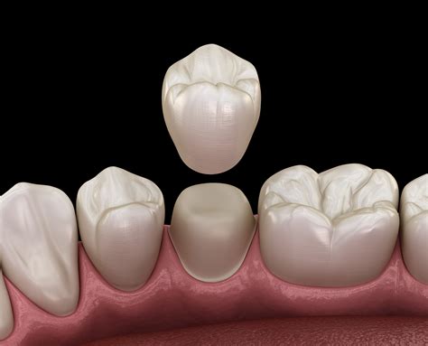 The crown simply will not be able to hold it at that point. Overland Park Dentist Explains How A Crown Fixes Broken ...