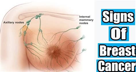 However, not all lumps are cancer. How To Know if You Have Breast Cancer Male or Female ...