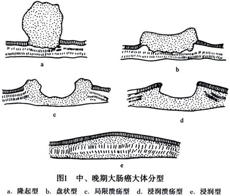 The site owner hides the web page description. 盆腔內有較廣泛浸潤,盆腔內有較廣泛浸潤的治療_盆腔內有較廣泛浸潤的原因,盆腔內有較廣泛浸潤怎麼辦_症状 ...