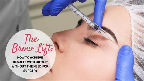 Botox and sculptra can be added.the golden. The Brow Lift: How to Achieve Results with BOTOX®, without ...